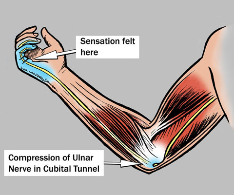 Cubital Tunnel Syndrome Tamarac, FL  Upper Extremity Specialist Coral  Springs, FL