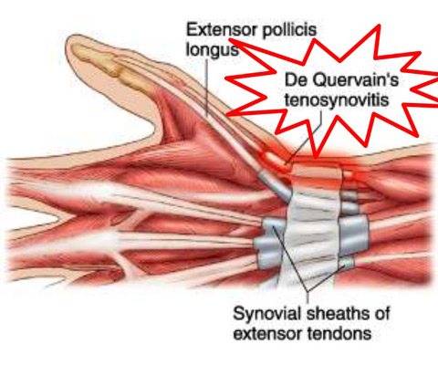 De Quervains Tenosynovitis Musculoskeletal What We Treat The Best